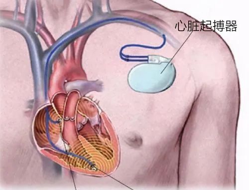 政策解读 | 进口心脏起搏器有哪些监管要求？
